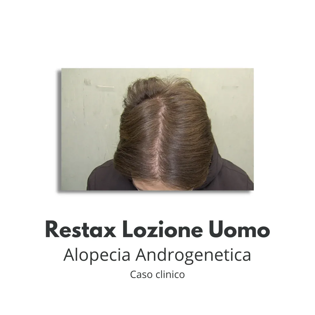 alopecia androgenetica