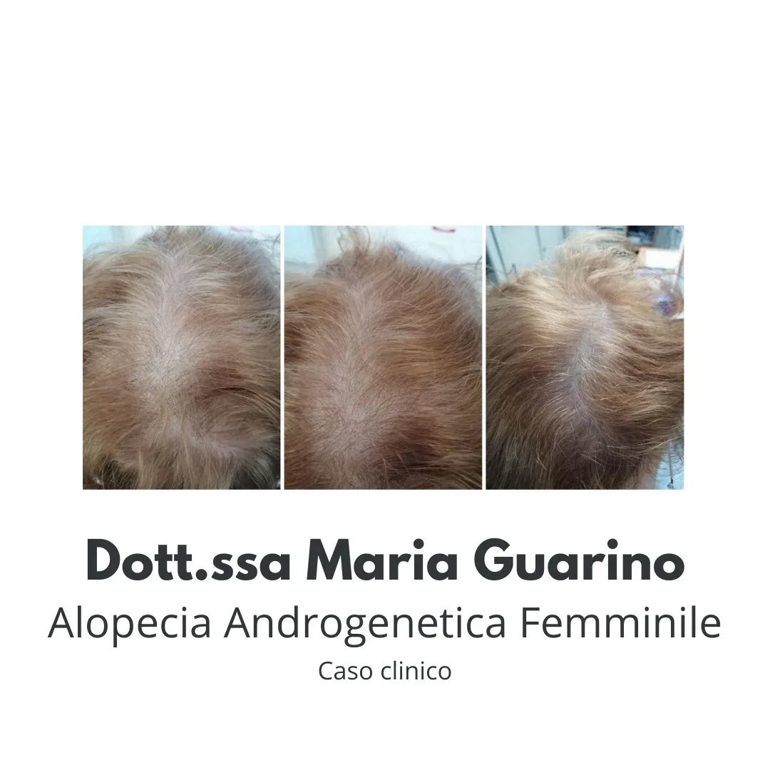 alopecia androgenetica femminile