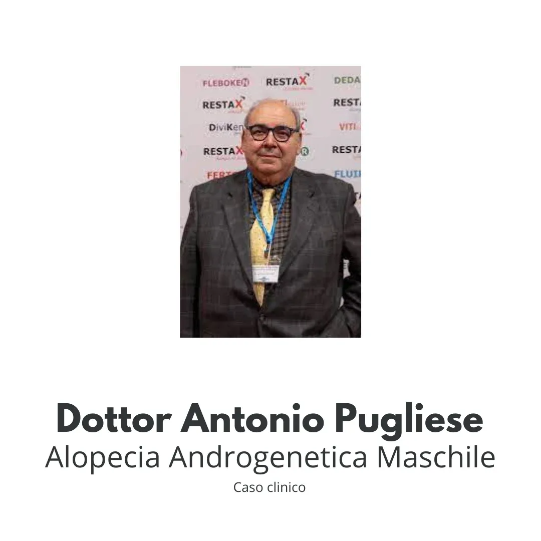alopecia androgenetica maschile
