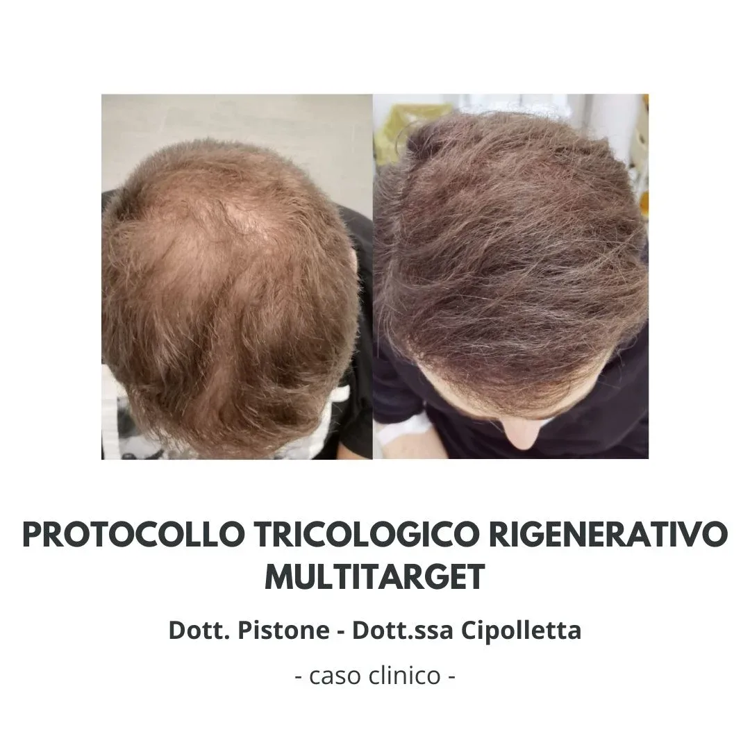 protocollo-pistone