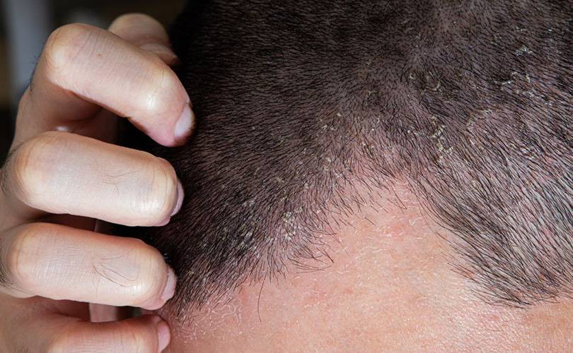 alopecia-seborroica