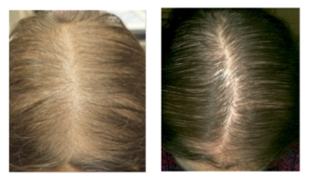 caso clinico alopecia femminile postmenopausa